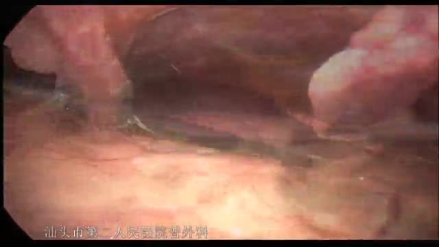 腹腔镜十二指肠穿孔修补术2