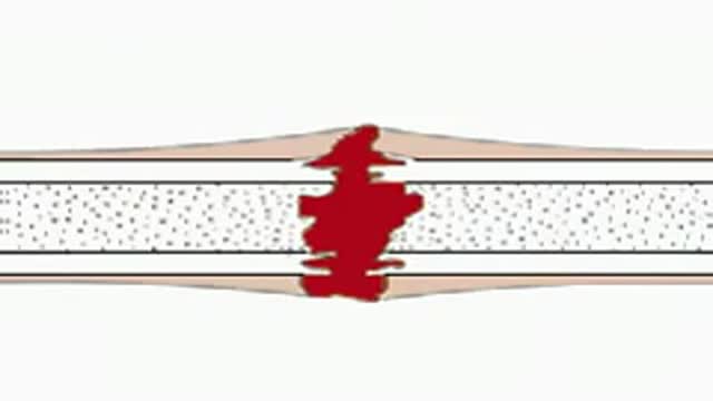 Bone Repair Animation