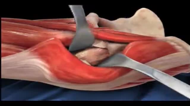 Total Hip Replacement Animation