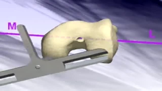 Total Knee Replacement Surgery Animation