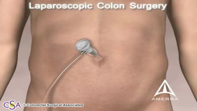 Colorectal Cancer Laparoscopic Surgery 3D Animation