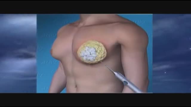 ⁣Gynecomastia 3D Animation