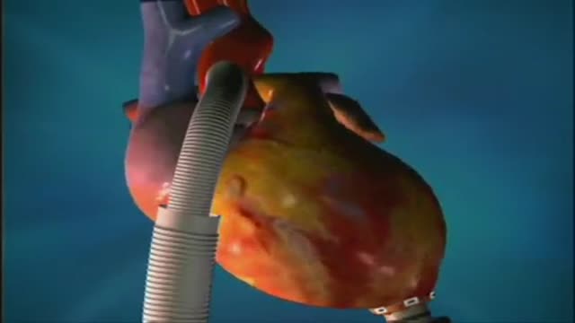 ⁣Ventricular Assist Device How It Works