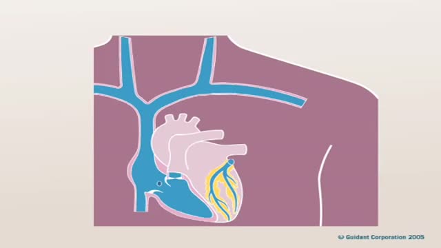 Pacemaker Implantation 3D Animation