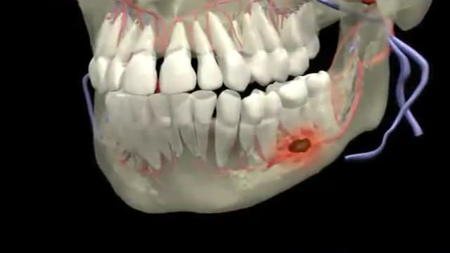 Dental Abscess 3D Animation