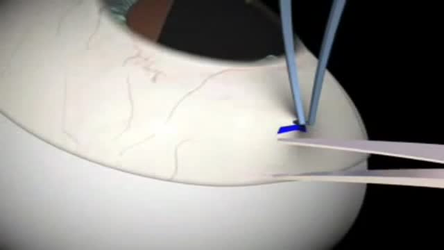 ⁣Glaucoma Surgery 3D Animation