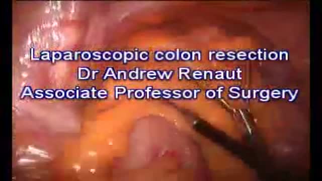 ⁣Laparoscopic Colon Resection