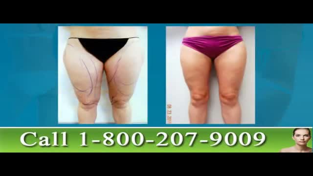 Tampa Thigh Liposuction – Leg Lipo