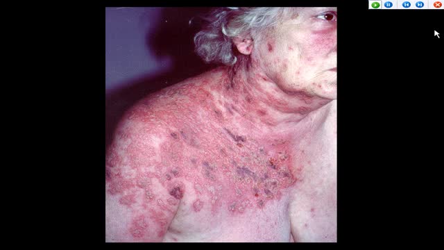 ⁣AUTO-HEMOTHERAPY IN HERPES CASES