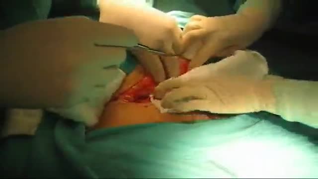 Emergency C-Section Misgav Ladach in an obese mother