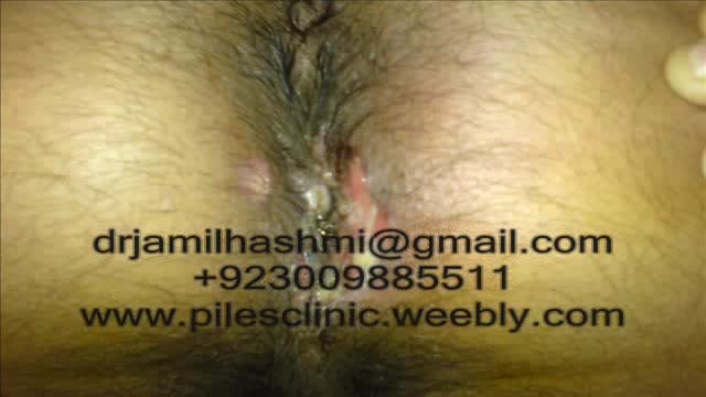 ⁣Treatment for Piles,Fistula,hemorrhoids, Hydrocele Without Operation or surgery  in pakist