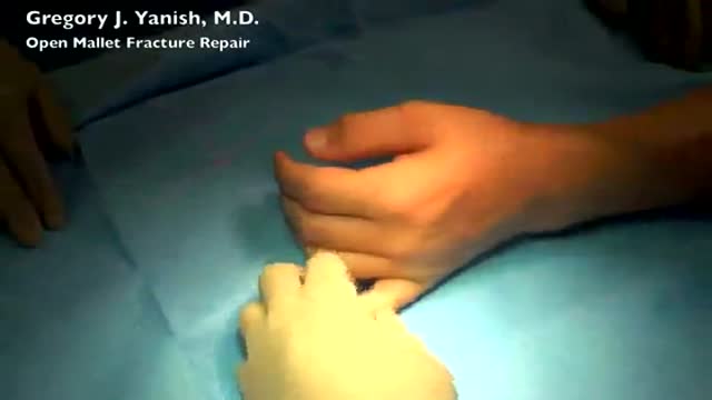 Open Mallet Fracture Repair Surgery