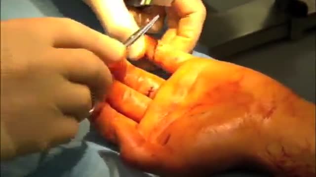 Flexor Tendon Repair Procedure