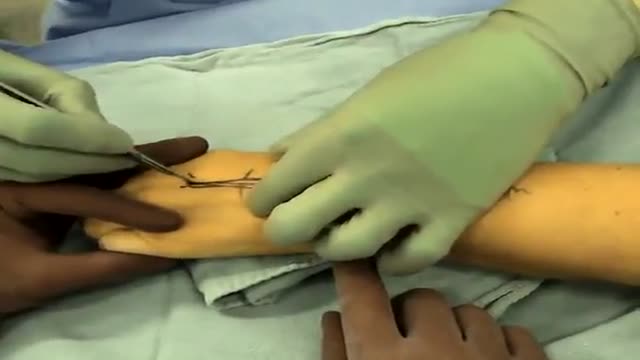 Total Wrist Arthroplasty Procedure