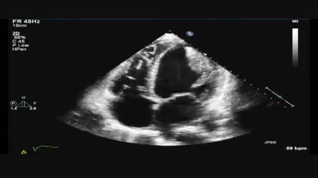 ⁣Transesophageal Echocardiogram of a Giant Thrombus in the Left Ventricle