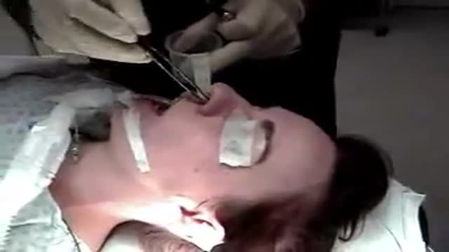 Open Rhinoplasty without oseotomies