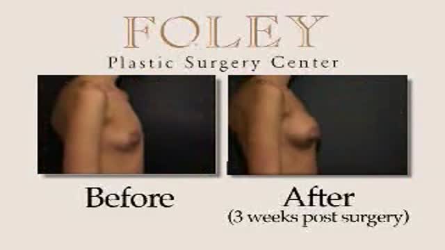 ⁣Breast Augmentation Surgery