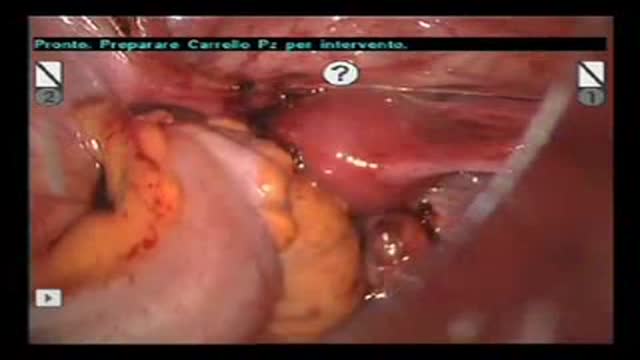 ⁣Rectal resection for Endometriosis