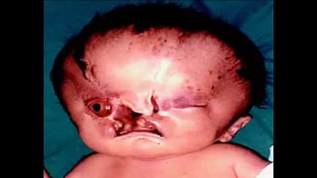 Holoprosencephaly with cyclopia and otocephaly