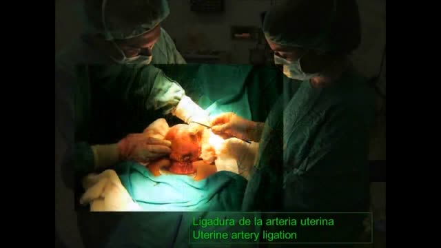 ⁣Uterine artery ligation