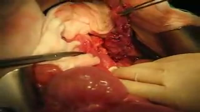 Pancreatectomy