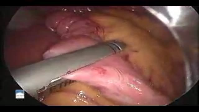 Laparoscopic Roux-en-Y Gastric Bypass