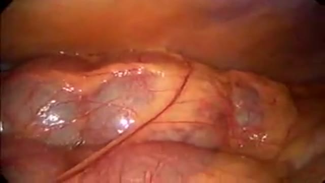 ⁣Laparoscopic Appendectomy Surgery