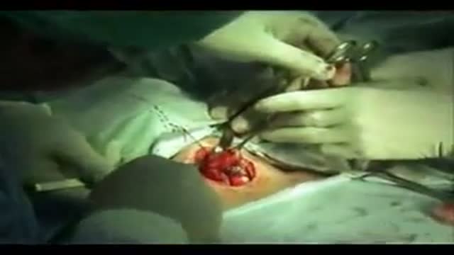 Thyroidectomy surgery