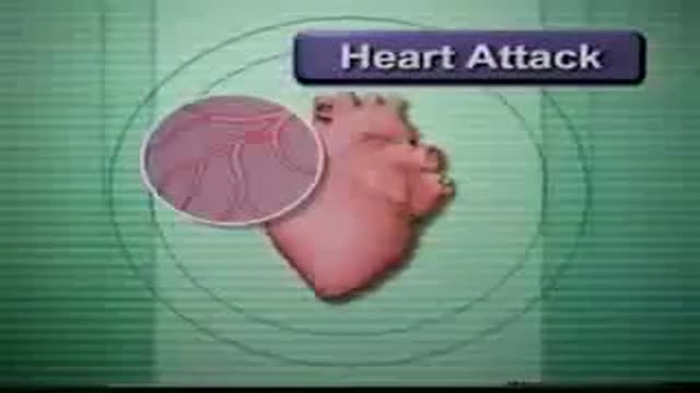 ⁣Heart Attack and Stroke