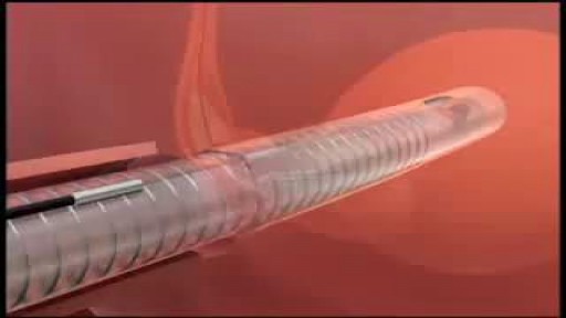 Male Urethral Stent Catheterization