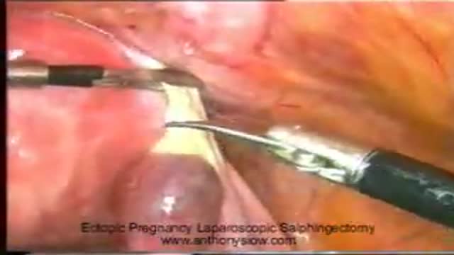 Tubal Ectopic Pregnancy Salpingectomy