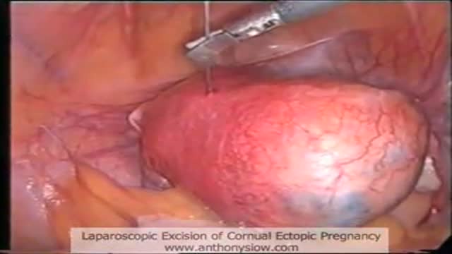 Cornual Ectopic Pregnancy