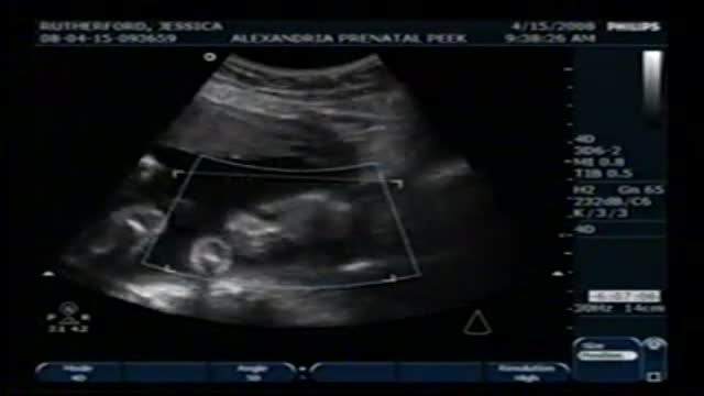 4D Ultrasound 23 Weeks