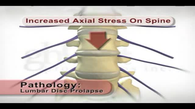 Lumbar Disc Prolapse Animation