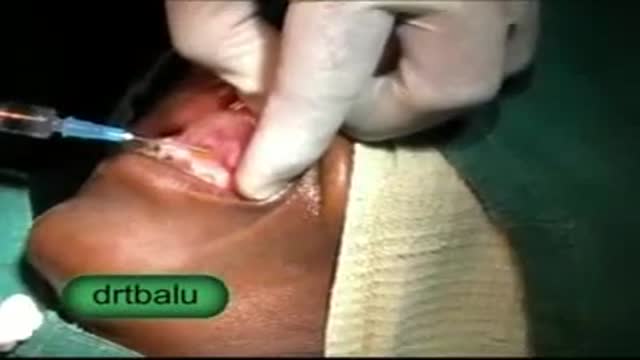 Nasolabial cyst excision