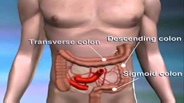 Cancer Colon Surgery