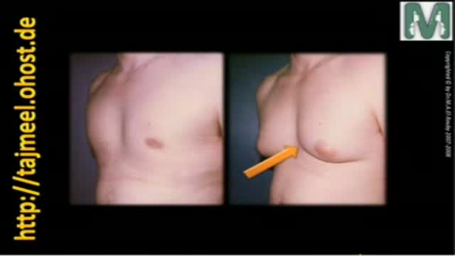 Gynecomastia تصغير الثدى للرجال Dr. M. El-Rouby د. الروبى