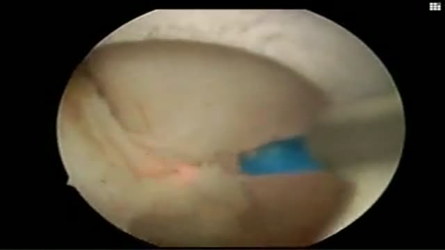 HoLEP (Holmium laser enucleation of prostate)