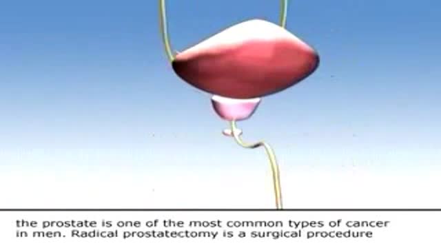 Prostate Cancer - Radical Prostatectomy