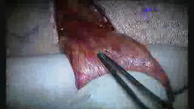 Microsurgical Varicocelectomy for Varicocele