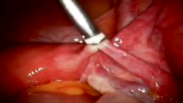 ⁣Tubal Ligation with Fallope Ring