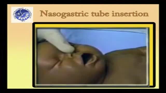 ⁣Pediatric Nasogastric Intubation