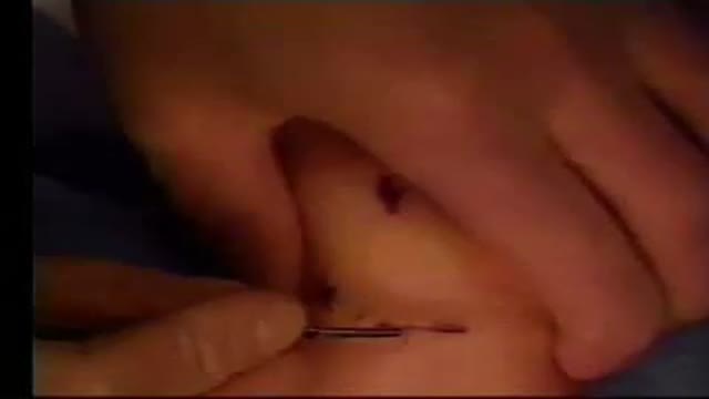 Endoscopic Carpal Tunnel Release Surgery