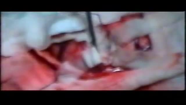 Hydatid Cyst Removal (Brain Surgery)