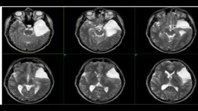 Endoscopic fenestration of arachnoid cyst