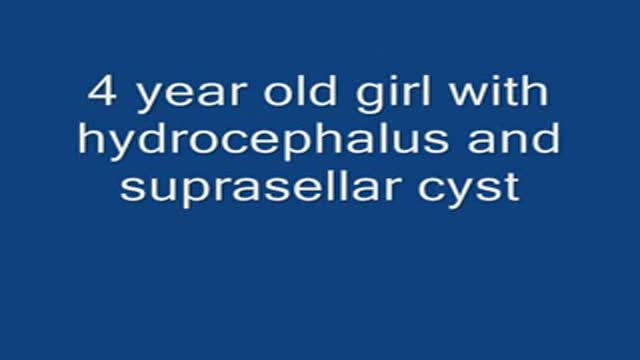 Endoscopic fenestration of suprasellar cyst