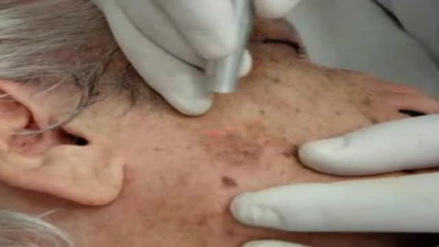 skin spots treated with Co2 laser