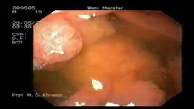 ⁣Removal of multiple stomach tumors