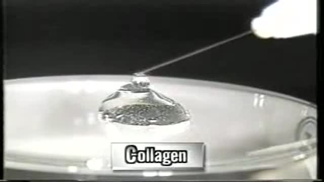 Endoscopic assisted pocket grafting of autologous collagen