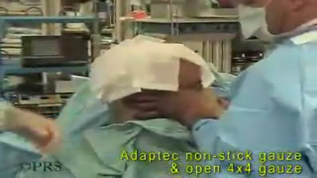 Above knee Amputation